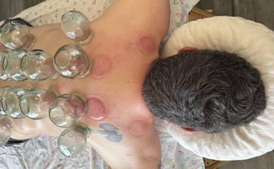 Fire cupping
